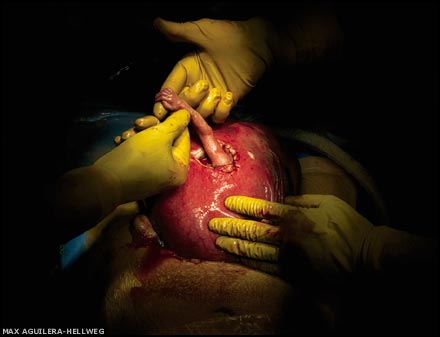 A 24 week fetus reaches out his hand during surgery